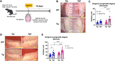 Epithelial-to-mesenchymal transition, inflammation, subsequent collagen production, and reduced proteinase expression cooperatively contribute to cyclosporin-A-induced gingival overgrowth development